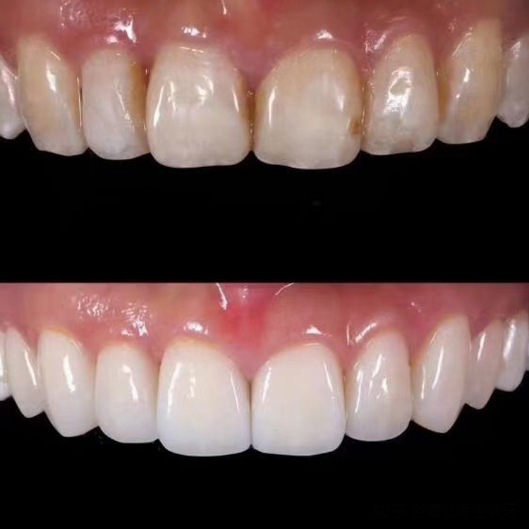 Parche de cerámica sin metal Eyingjia Denberg porcelana azul ámbar Lingxi porcelana hecha a mano sin moler