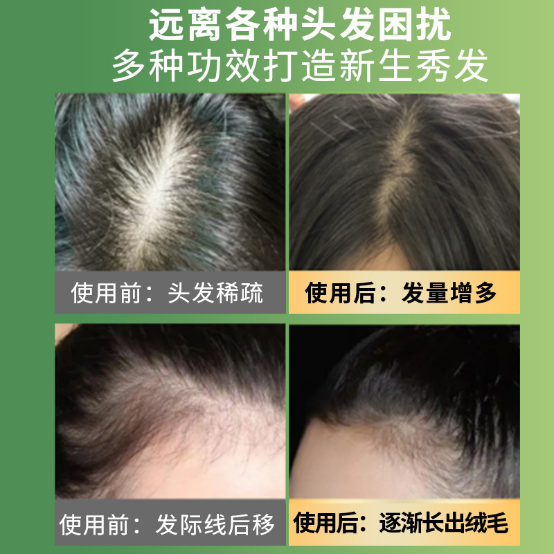 ビデオ番号人気のカンフー抗脱毛シャンプー育毛ヘアケアシャンプーBinglu生姜植物エキスシャンプー|undefined