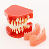 Dental teaching model doctor-patient communication model comprehensive case model removable dental model implant restoration model