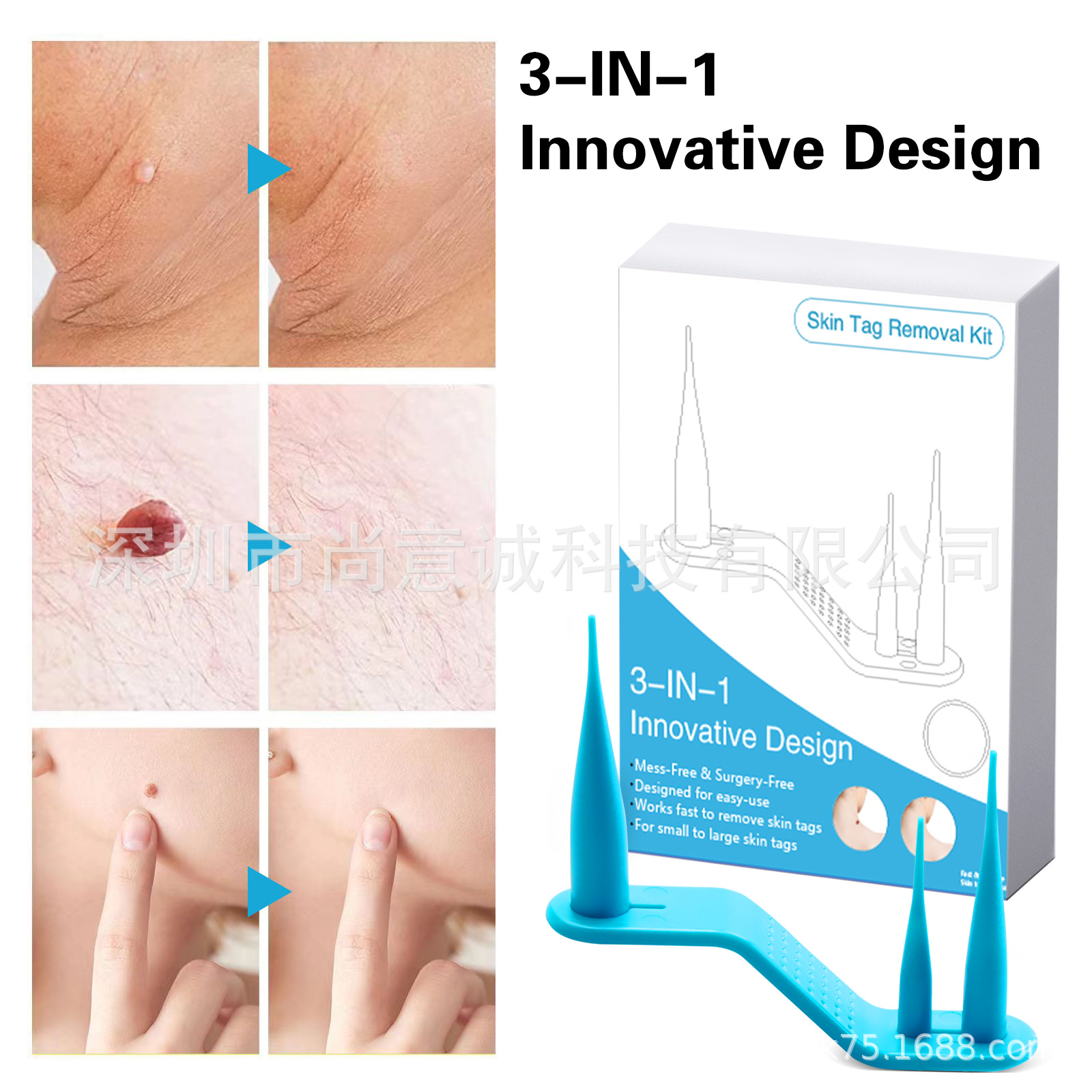 Cross-border simple wart Removal tool Skin Tag Removal wart Removal pen neck flesh pimples filiform wart