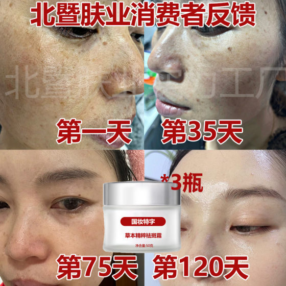Freckle Removal Cream Whitening Melanin Removal Source Age Spots Removal Freckles Chloasma Color Spots Morning and Evening Strong Frying Cream