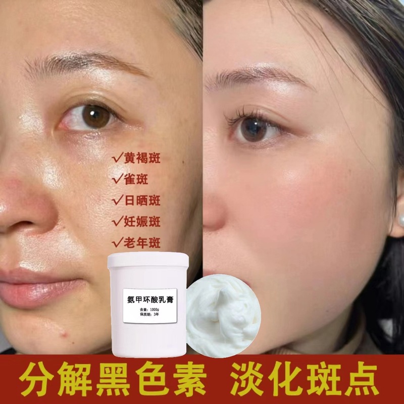 Tranexamic Acid Cream (Tranexamic Acid) Removes Dullness, Removes Melanin, Brightens Skin, Beauty Salon Color Control Cream