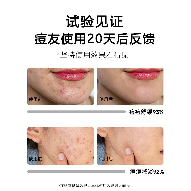 草本はニキビクリームを消してニキビ跡を薄めてニキビ穴に行ってにきびを閉じます。|undefined