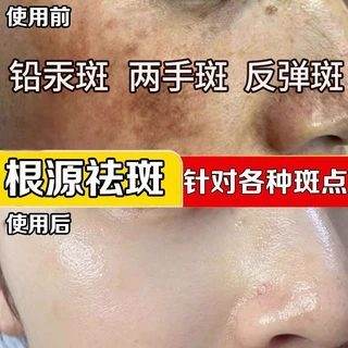 无尴尬期祛斑液去斑液美容院专供去铅汞斑两手斑反弹斑排色液套装