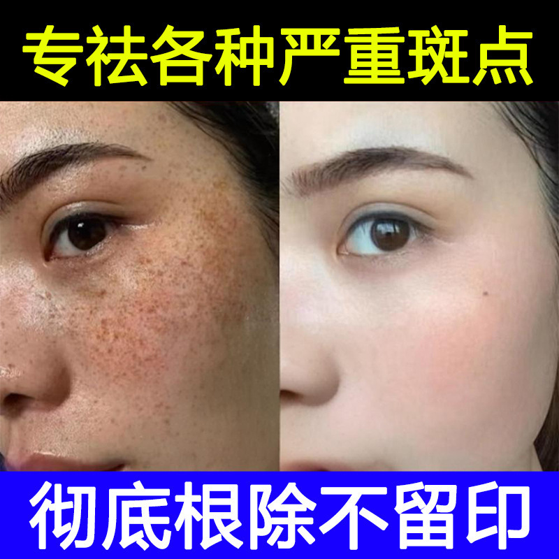 美容室の非侵襲性スポット溶解液、非ピーリング、スポット除去液、メラニン分解、スポット除去、スポット美白エッセンス|undefined