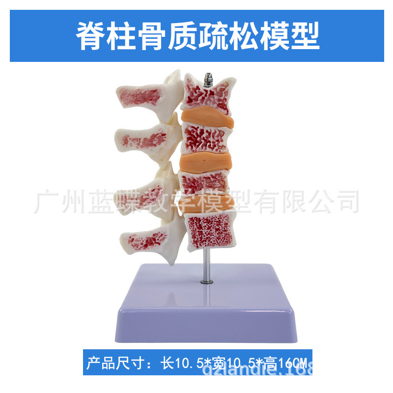 Bone vegetable pine model spine typical lesion model human spine model osteoporosis mold