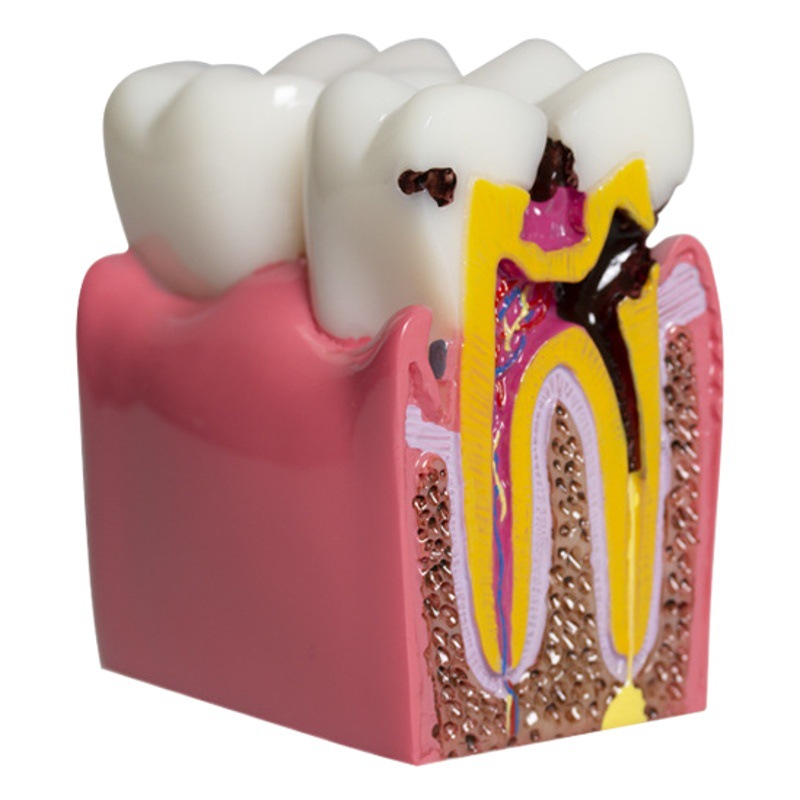 Equipo de enseñanza dental, modelo de comparación de caries 6x, modelo oral, modelo de enseñanza, modelo de dientes