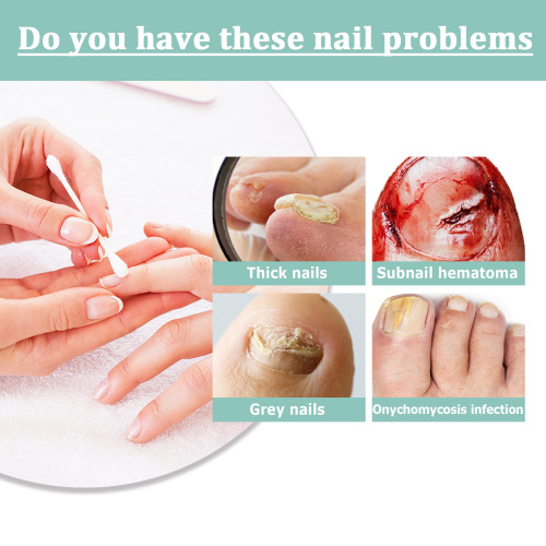 South Moon Nail Repair Pen Onychomycosis Care Solution Cleansing, Brightening, Thickening Onychomycosis Repair Pen