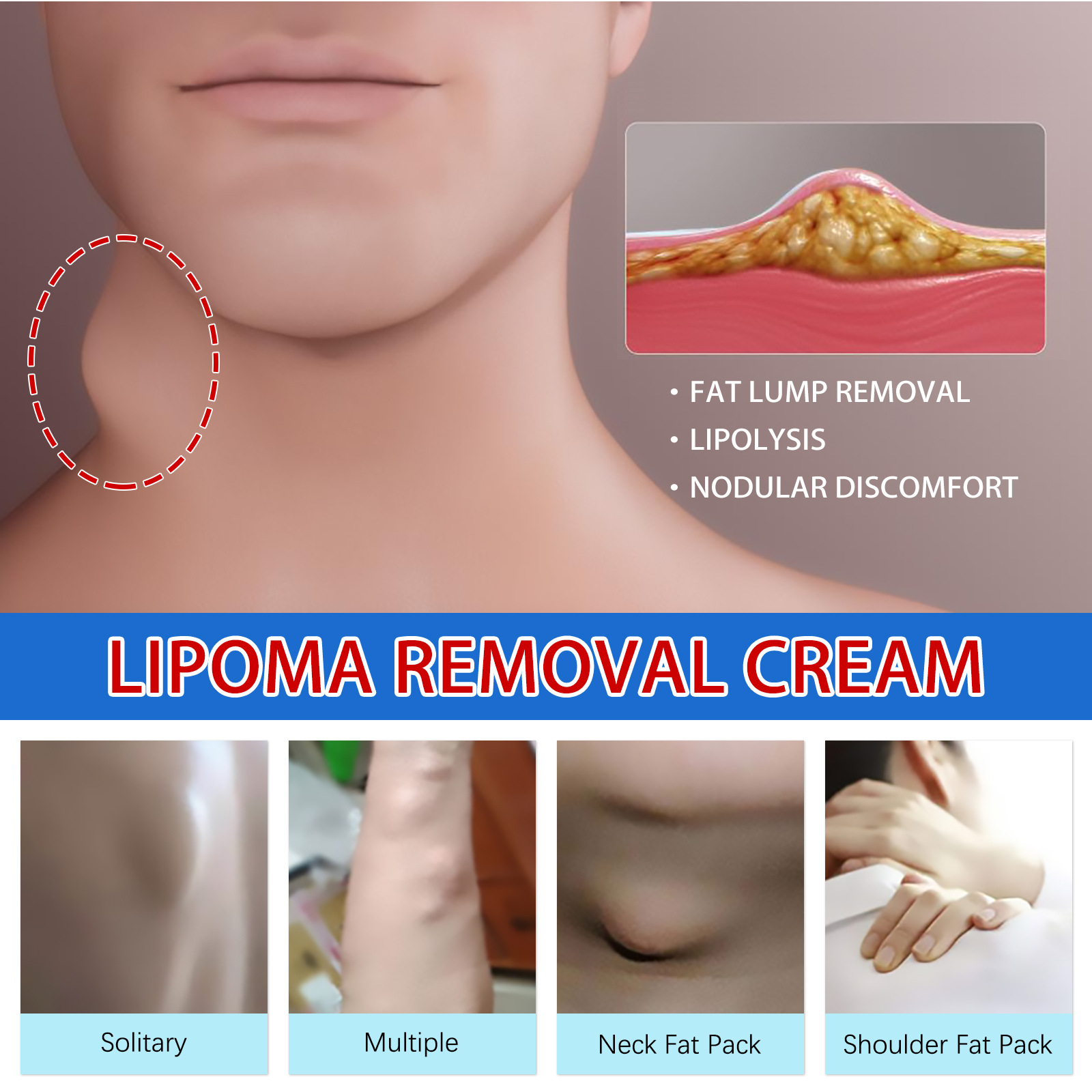 South Moon fat knot cream to relieve fat caking tumor subcutaneous lump dredge body care cream