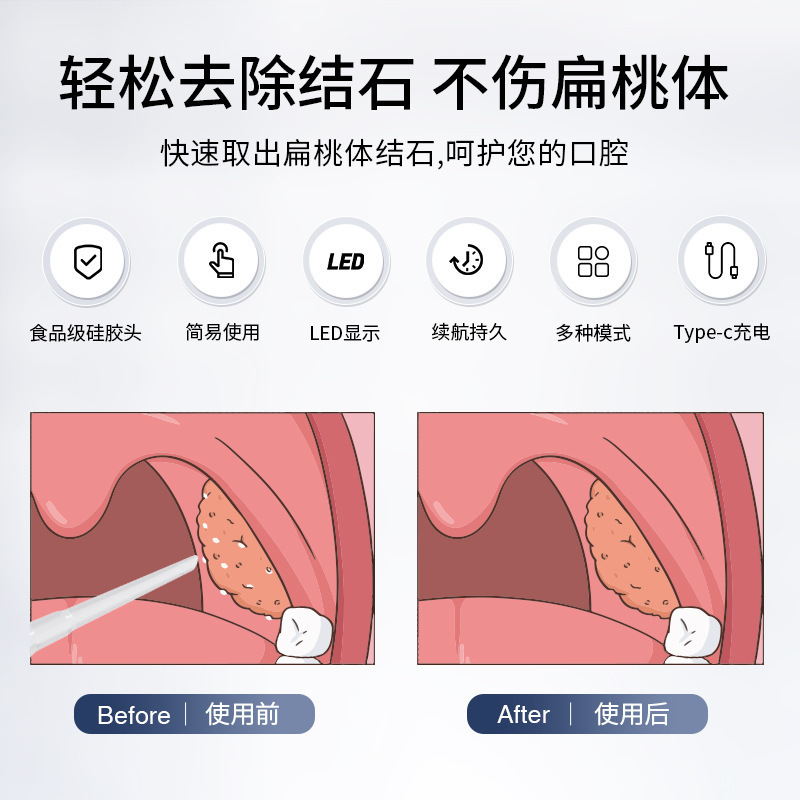 新品扁桃体结石吸取器电动清除器口腔清洁护理工具去除结石器跨境|undefined