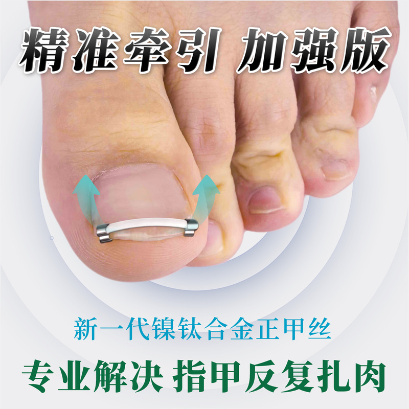 Nail Correction Patch Nickel-Titanium Alloy Nail Correction Patch Anti-Pull Ingrown Nail Correction Hook Nail Correction Buckle Nail Groove Correction