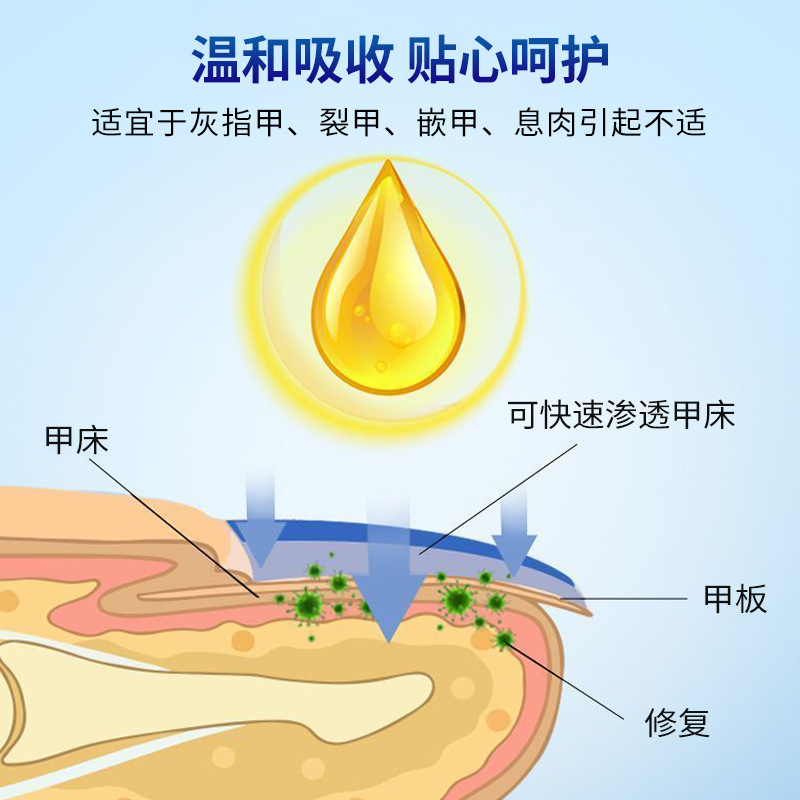 北京协和灰甲康外用保健液灰指甲裂甲嵌甲息肉引起不适护理液批发|undefined