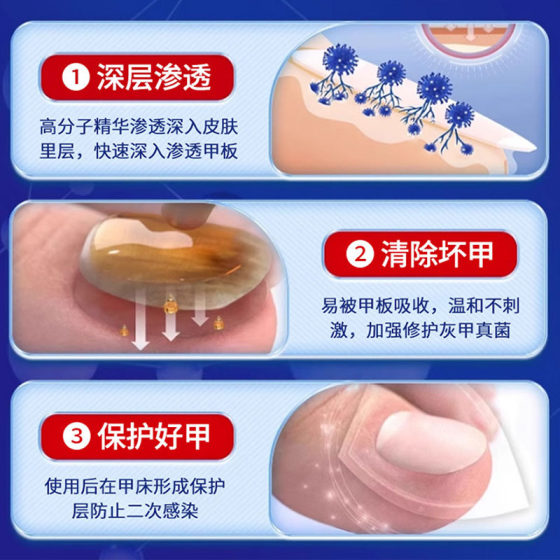 Special antibacterial liquid for onychomycosis nail removal ointment thickening soft nail onychomycosis health special liquid medicine wholesale suit