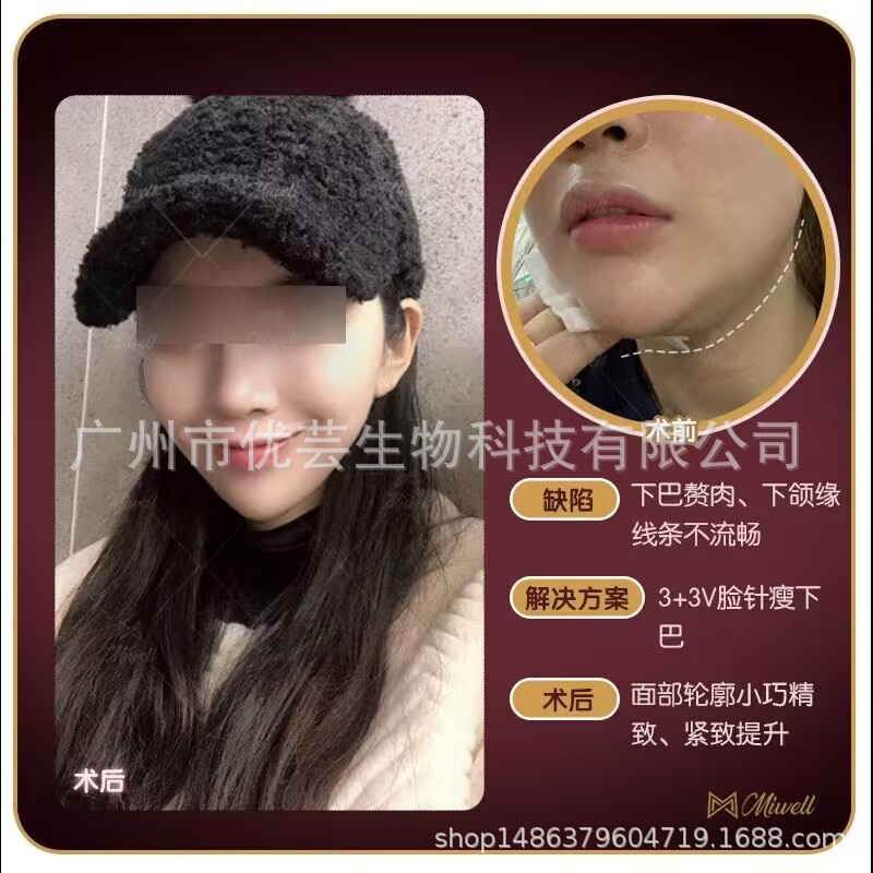 韓国で最も美しい脂肪溶解アイスムーイラングリーン溶融彫刻顔二重あごボディスリミングとスリム化など|undefined