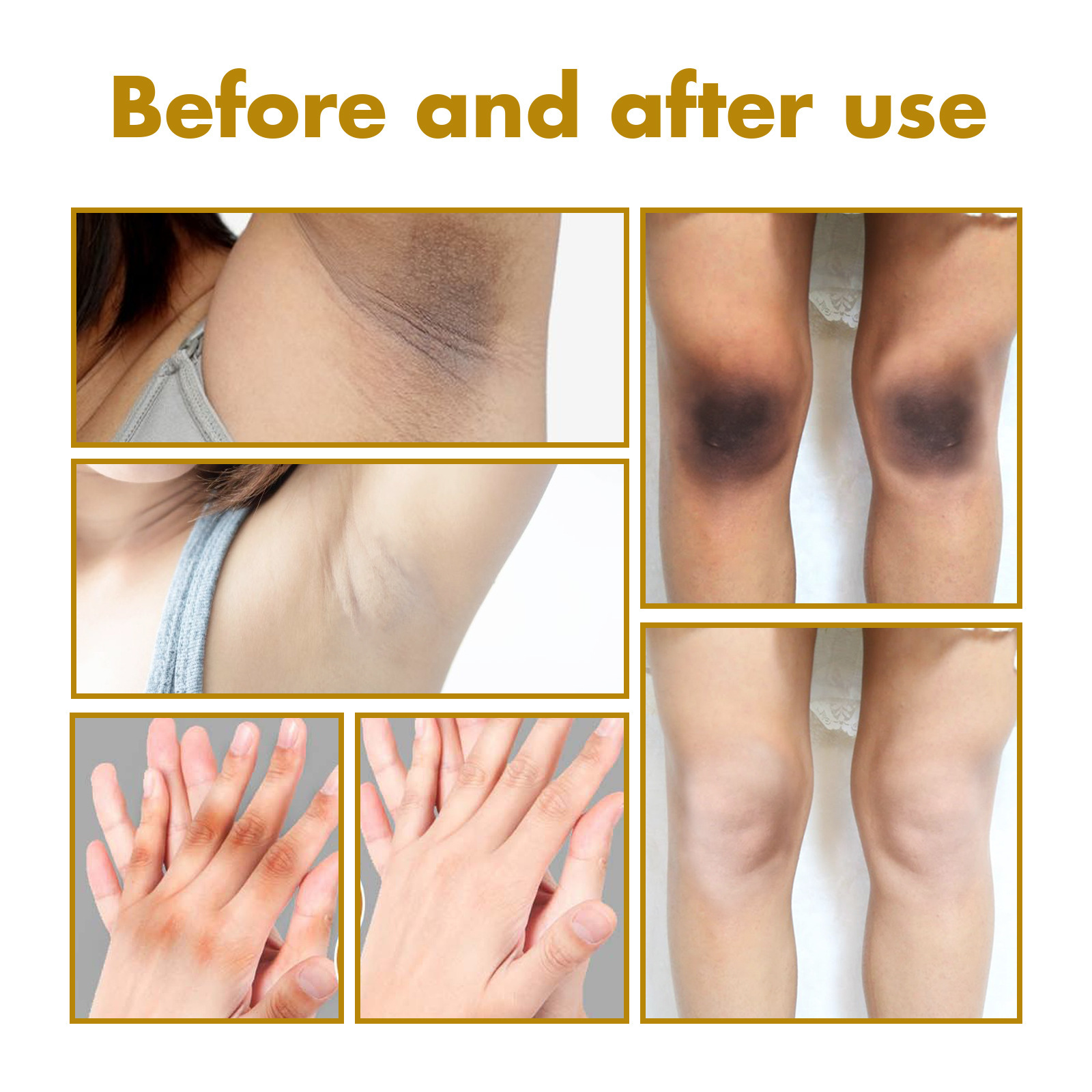 Huile éclaircissante pour traitement de l'acanthosis nigricans_voghion.com