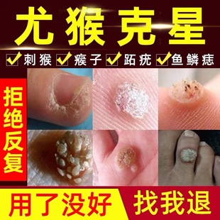 刺猴鸡眼膏去猴子肉粒疙瘩鱼鳞痣药祛疣瘊子跖疣脖子上长的小肉粒-阿里巴巴