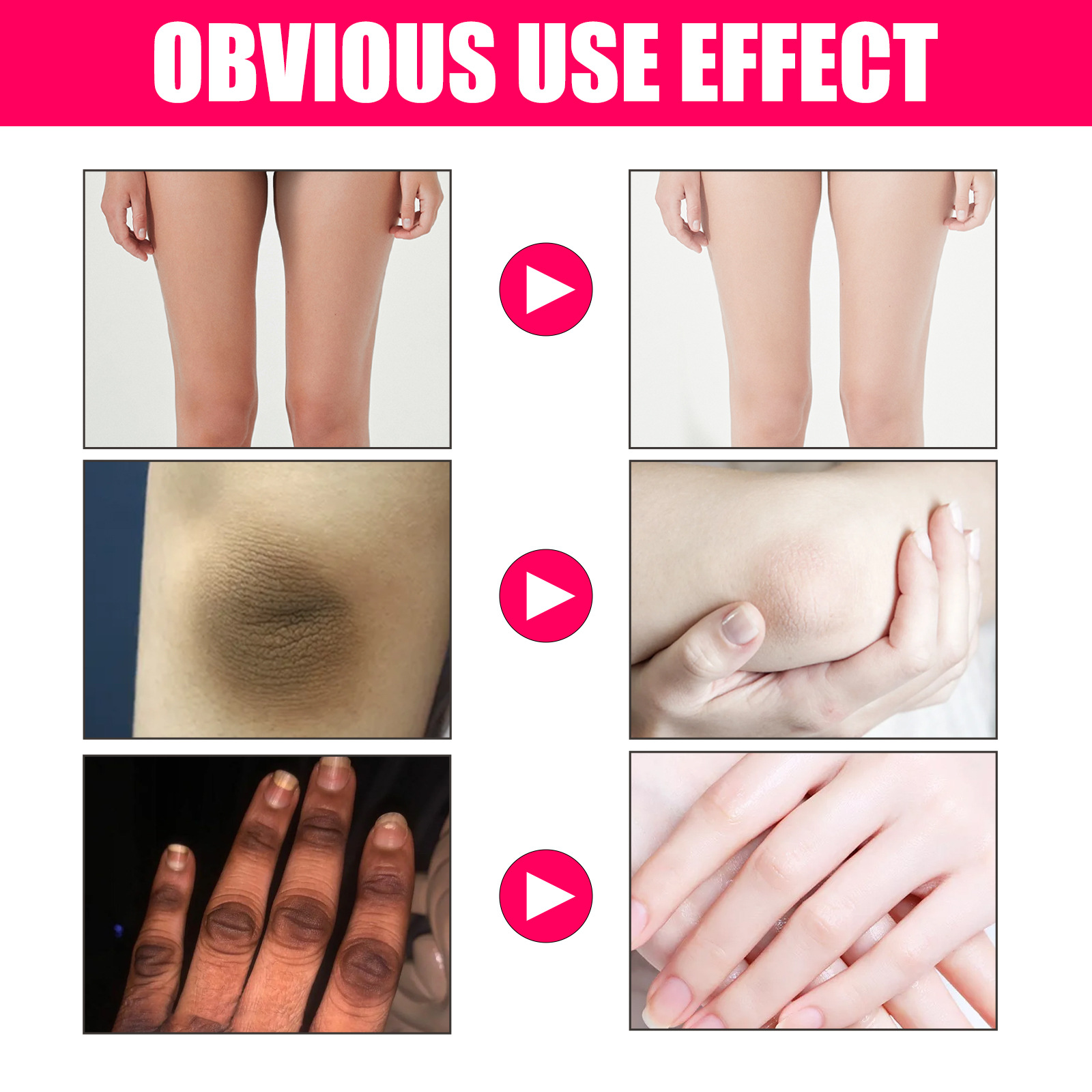 EELHOE Γυναικείο Δέρμα Beautifying esse για λεύκανση, λεύκανση και αποχρωματισμό των αρθρώσεων της μασχάλης, μελάγχρωση του δέρματος_voghion.com