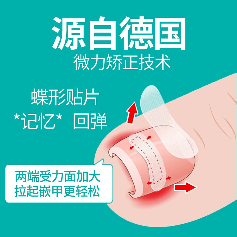Fifth Generation Easy-To-Apply Butterfly-Shaped Stickers with Frosted Design, Nail Correction Device for Ingrown Nails, Nail Groove Pain Inflammation Buckle Hook Wire Cutting Pliers Fifth Generation Easy-To-Apply Butterfly-Shaped Stickers with Frosted Design, Nail Correction Device for Ingrown Nails, Nail Groove Pain Inflammation Buckle Hook Wire Cutting Pliers