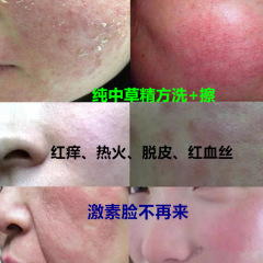 激素臉修護面霜修護紅血絲痤瘡退紅止癢面霜激素臉修護面霜