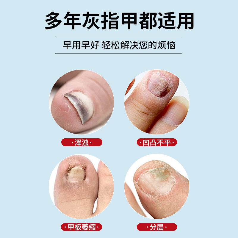 ドイツ爪真菌ペン爪真菌抗菌ジェル爪ケアオールインワンケアソリューション修復感染症腐敗抗菌液体|undefined
