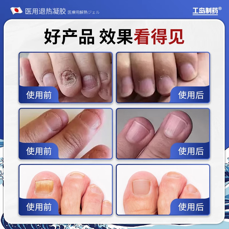 Kodajima Pharmaceutical 爪真菌症医療用解熱ジェル 公式正規品 プラットフォーム人気商品 1点発送可能|undefined
