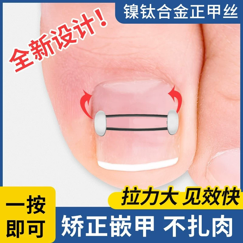 Никель-титановый сплав канавка для ногтей встроенный гвоздь стальной проволоки корректор ногтей патч для ногтей на ногах корректор воспаления