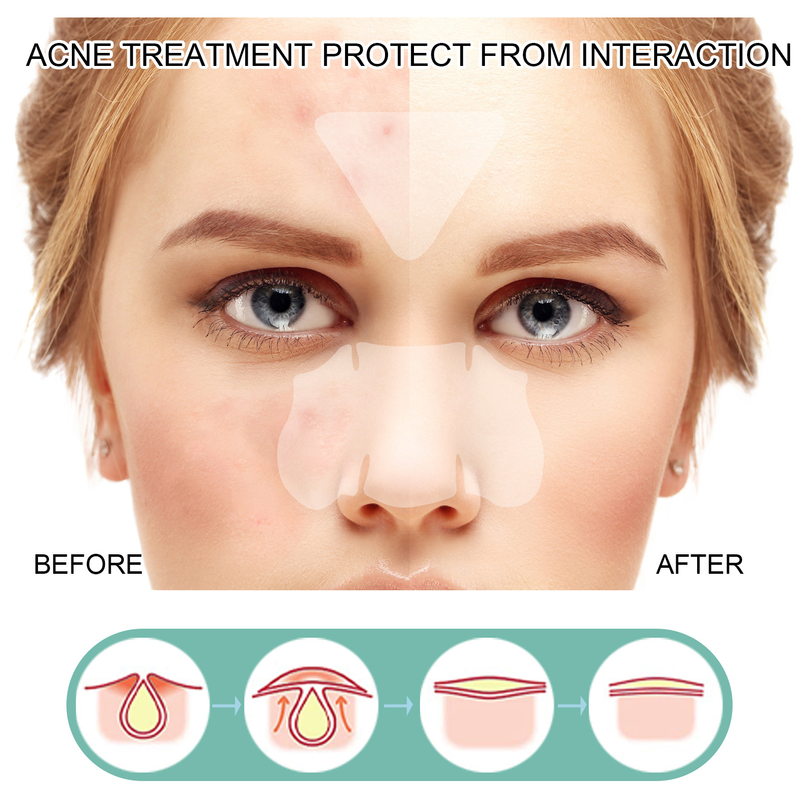 EELHOE Removing facial mask Mild and Non irritating Lighten Marks Healing Acne Repair Patch_voghion.com