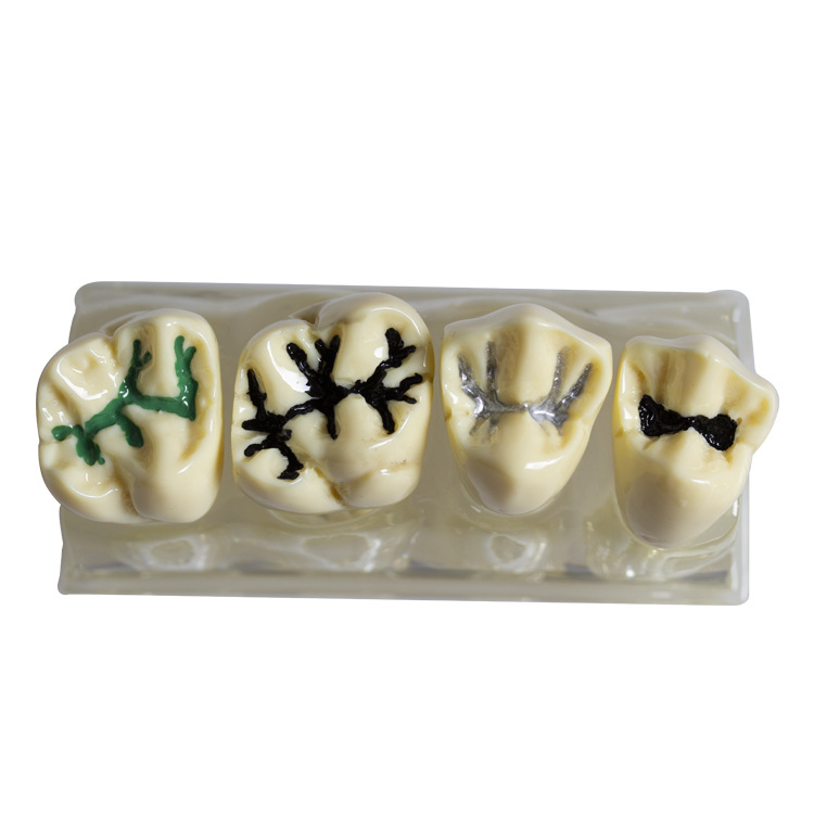 Modelo de cierre de fosas y fisuras dentales para niños contra la caries y la caries Modelo de cierre de fosas y fisuras Modelo transparente