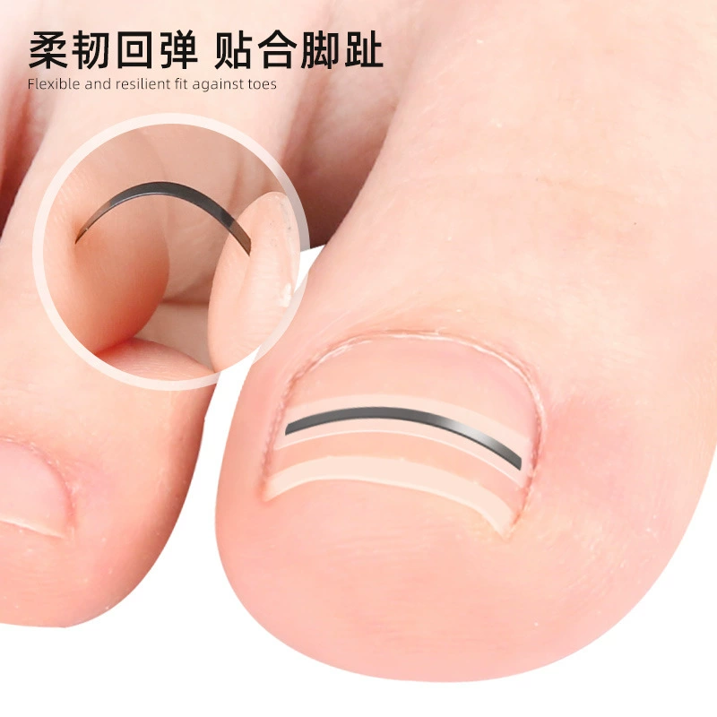 Nail patch, rolled nail, ingrown nail, nail patch, traction and pulling orthosis, toenail nail groove, nail patch, ingrown toenail.