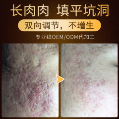 生机液安肤液修护凹坑豆坑长肉填平凹坑洞生长精华液美容院