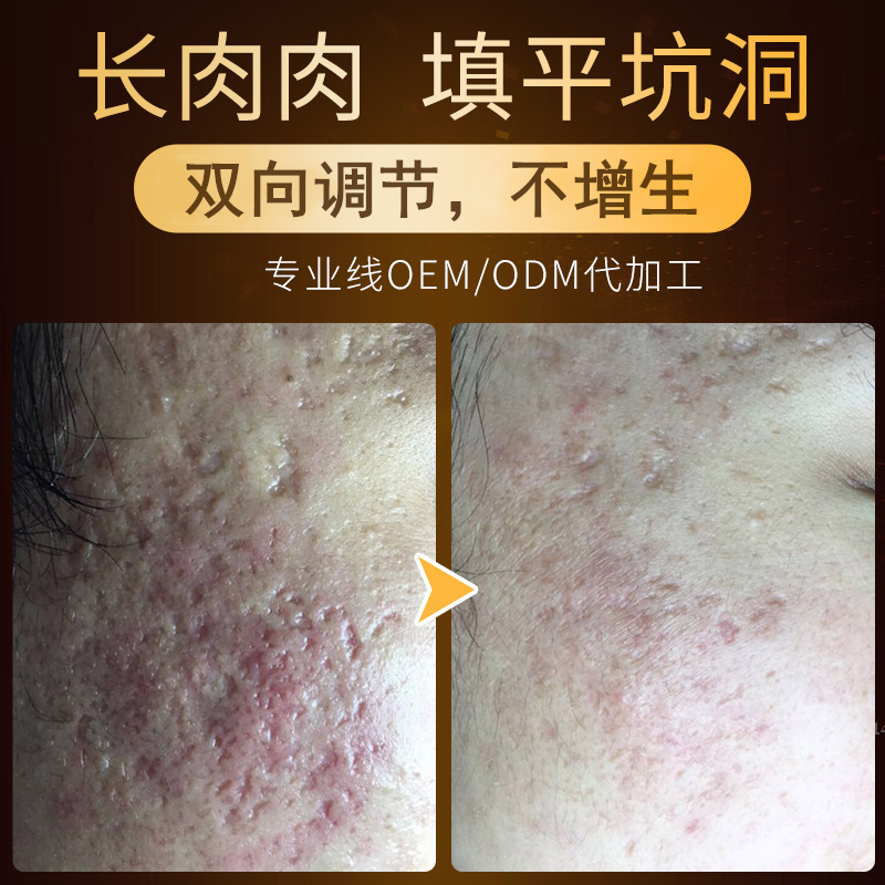 生机液安肤液修护凹坑豆坑长肉填平凹坑洞生长精华液美容院|undefined