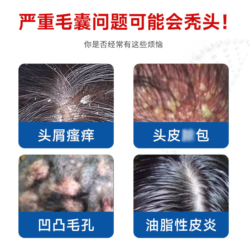 タイワンブルー 毛包ヘルスケアクリーム 毛包詰まりクリーム 頭皮ニキビ 皮膚かゆみ止めクリーム 皮膚炎クリーム 30g|undefined