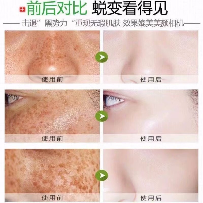 Beauty salon skin membrane for cleansing operation skin membrane for spot absorption to brighten skin tone to improve dark yellow acne removal herb tearing skin membrane