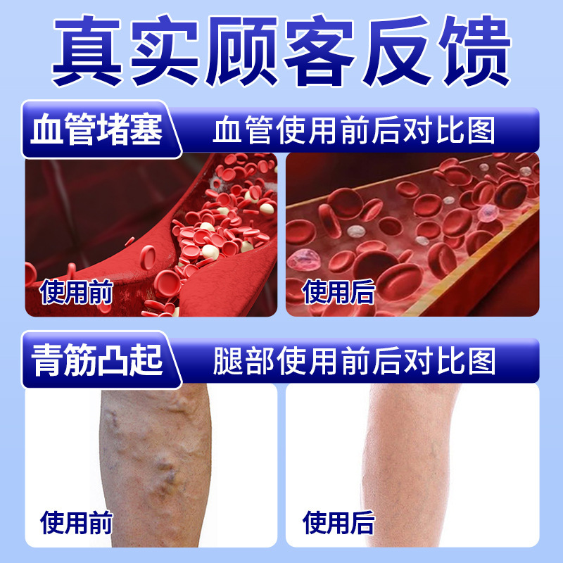 静脈瘤タイプ医療解熱冷湿布ジェル公式本物の足の腫れ鎮痛補助治療|undefined