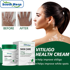South Moon Vitiligo Care Cream &mdash; Vitiligo, Sweat Spots, and Pityriasis Versicolor Body Skin Care Topical Skincare Cream