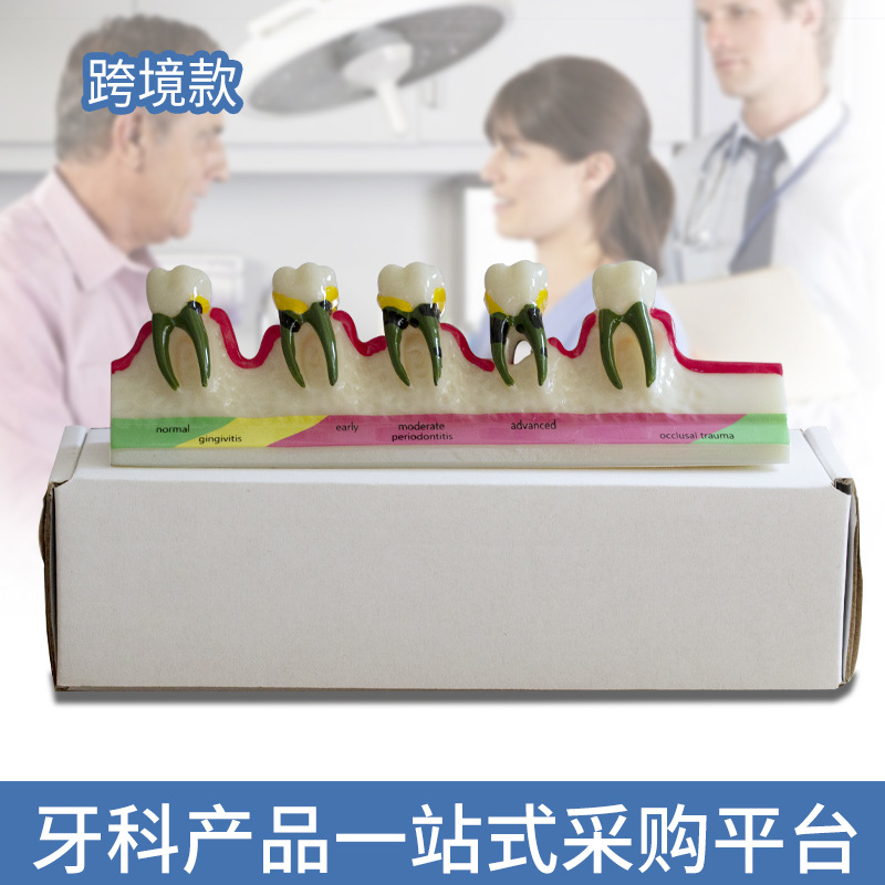 Modelo de clasificación periodontal modelo de caries dental modelo de visualización de caries dental