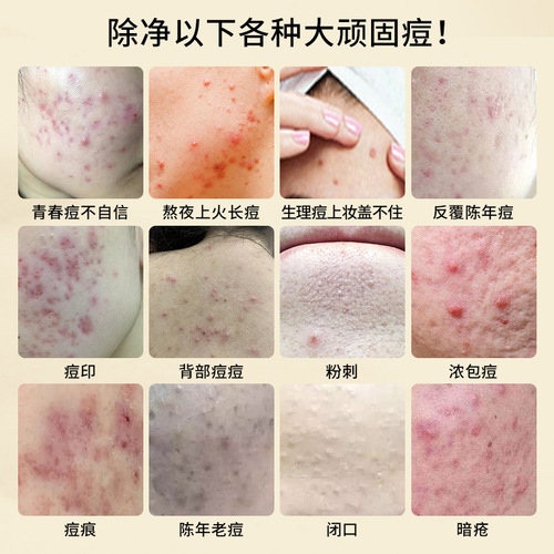 Beauty Salon Anti-acne Cream Salvia Anti-Acne Cream Acne Marks Pimples Pimples Closed Pimples Stubborn Acne Removes Redness and Swelling Pimples