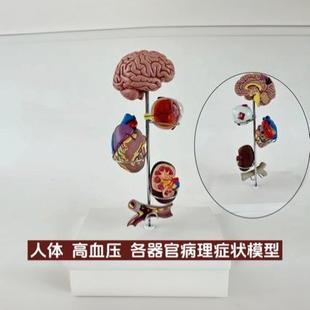 Human hypertension high organ symptom model demonstration detachable teaching disease foot disease pancreas eyeball heart