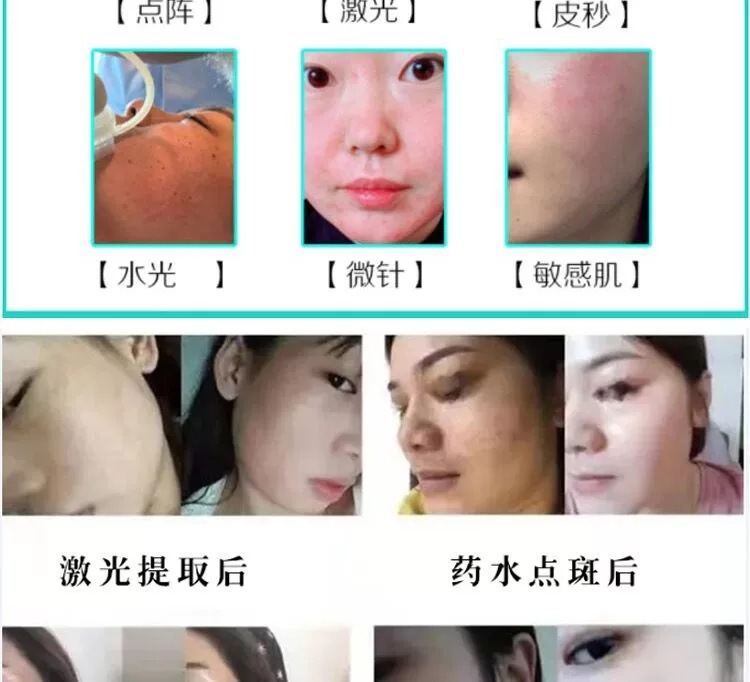 美容院修复因子面部修复膏点斑点痣烫伤破皮术后生长因子修护液-阿里巴巴