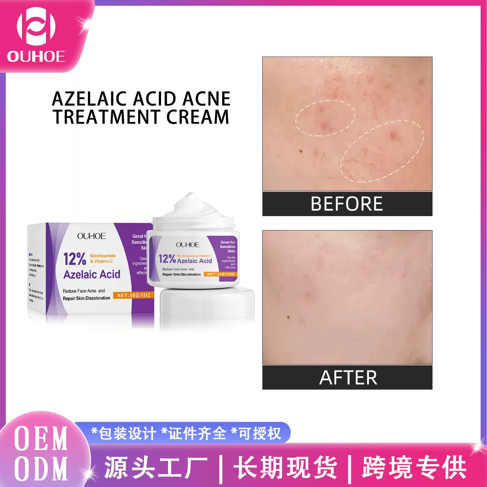 OUHOE壬二酸痘痘护理面霜 温和滋润改善面部痘痘提亮保湿润颜面霜