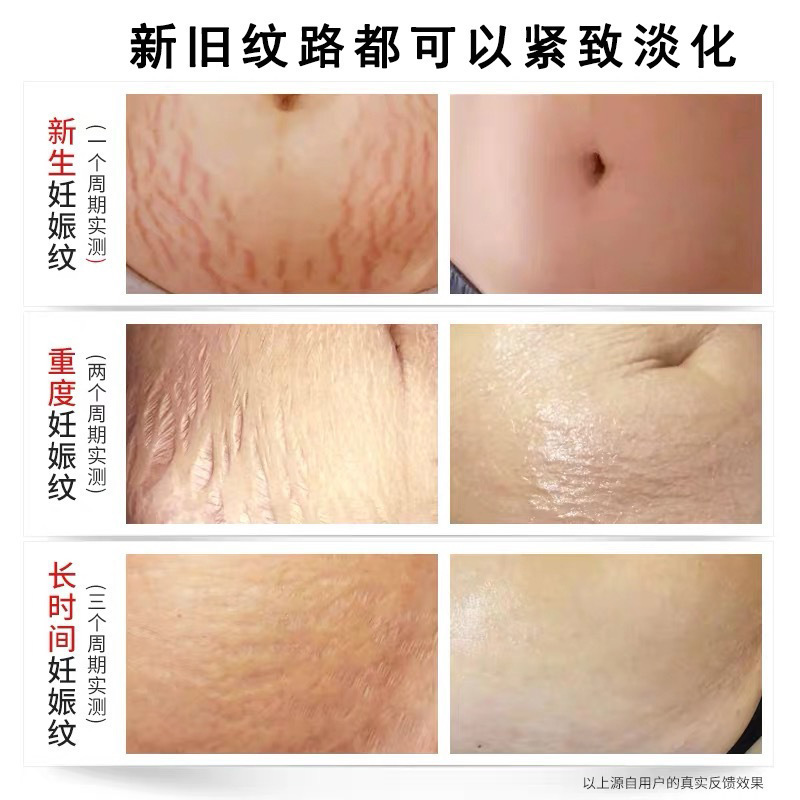 Stretch marks repair cream to remove obesity striae pregnancy striae orange peel growth striae postpartum care abdominal tightening light striae repair