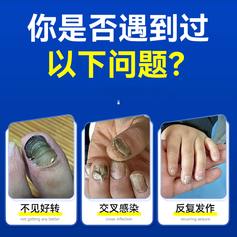 Teyijia Angel Skin 抗菌液体手足指爪真菌除去クリーム爪除去液体柔らかい爪肥厚と爪の除去|undefined