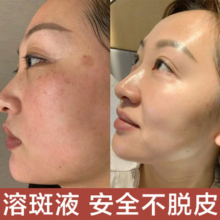Non-invasive Spot Dissolving Liquid, Non-peeling and Lightening Spots Essence, Beauty Salon Freckles, Sun Spots, Chloasma, Genuine Spot Essence
