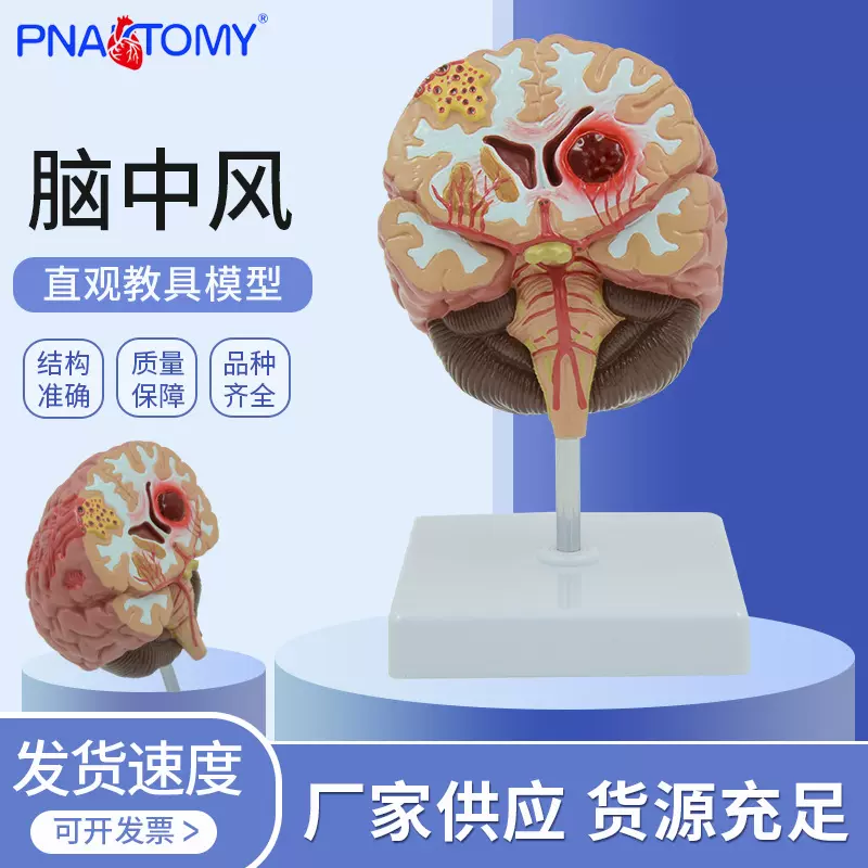 人体脑解剖模型 脑出血 动脉大脑动静脉畸形脑病理大脑教具