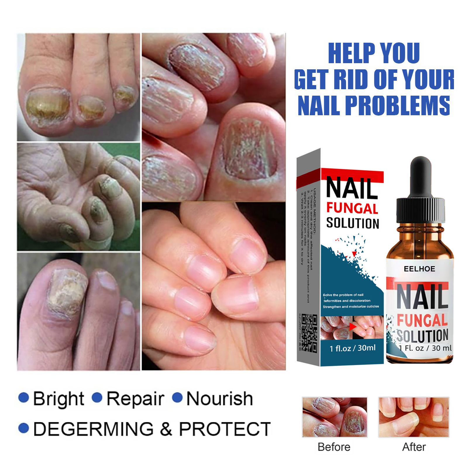 EELHOE Nail Repair Solution Hand and Foot Nail Fungus Care Repair Nail Fungus Liquid Thick Soften Nail