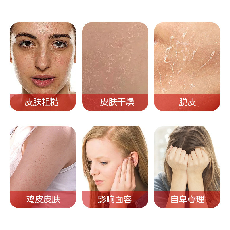 日本東京かゆみ止めクリーム男女適用皮膚不快皮膚かゆみ止め除菌外用ケアクリーム|undefined
