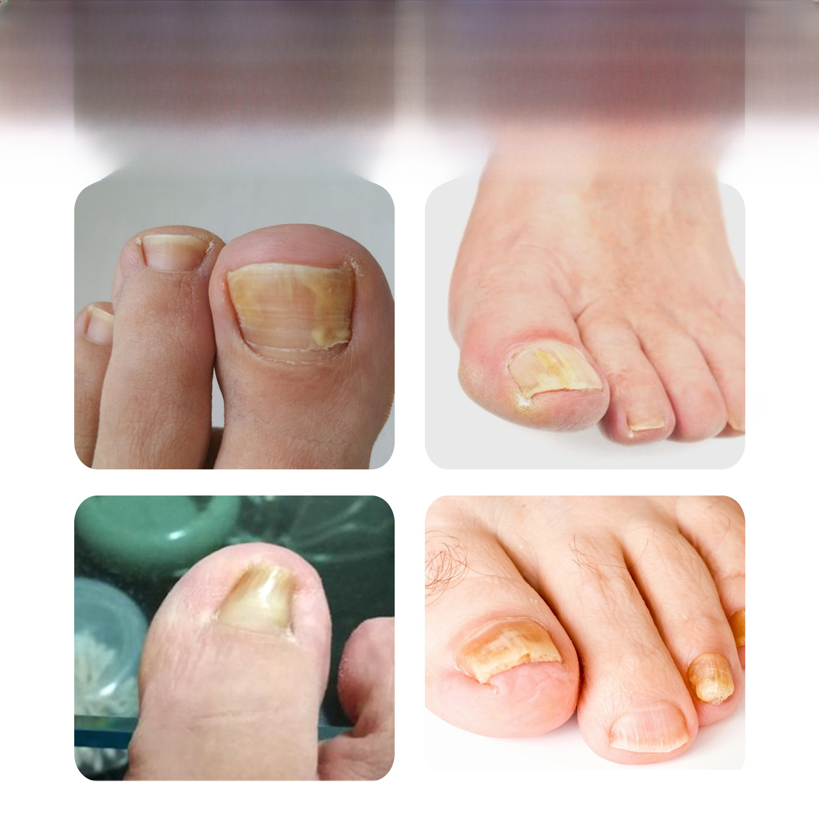 South Moon Intrinsic Nail Repair Essence, Nail Repair Cleansing, Gray Nail Fungus Treatment, Nail Care Essential Oil