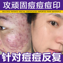 草本祛痘膏厂家淡化痘印去痘痘青春痘粉刺闭口舒修护美容院祛痘霜