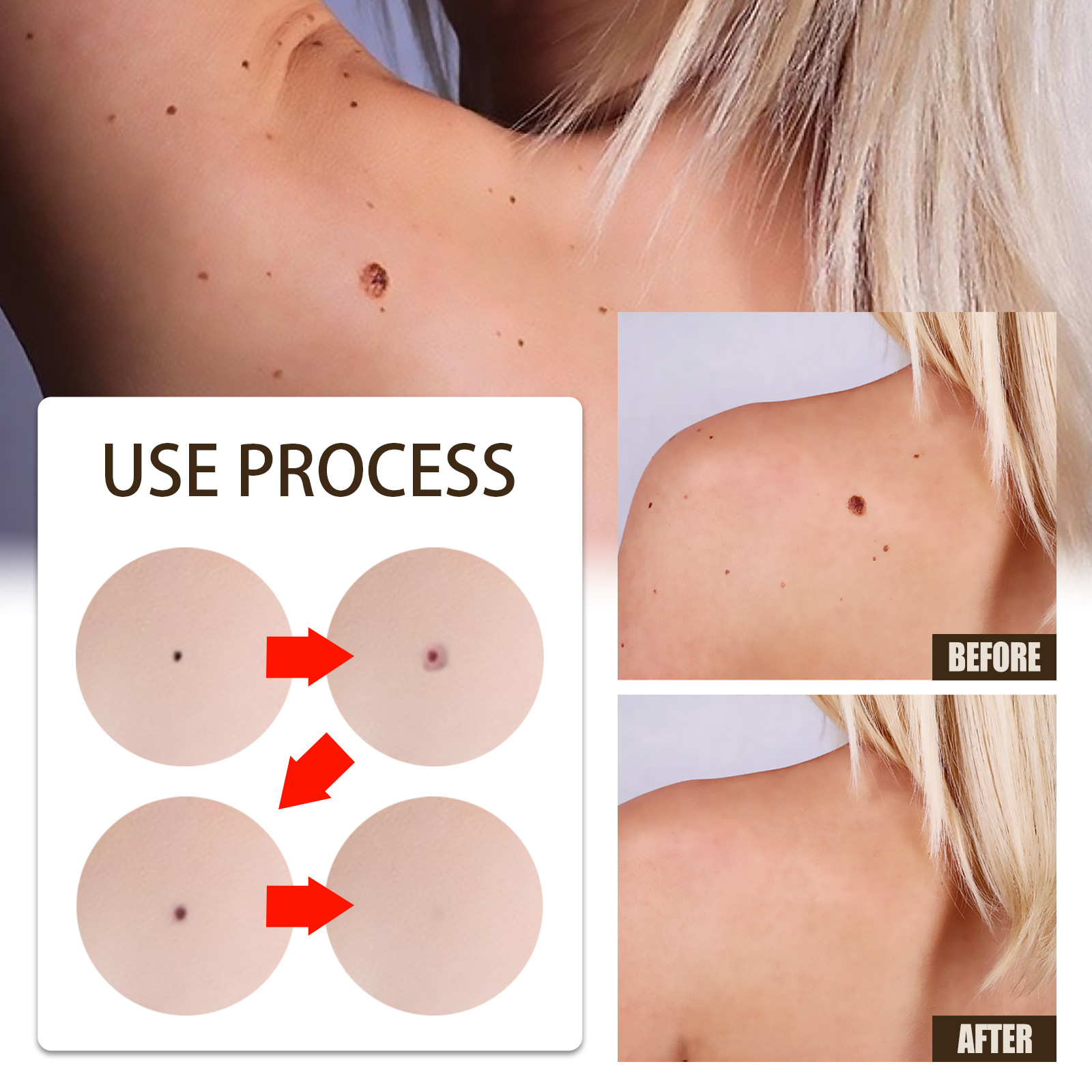 EELHOE wart oil repair for warts, black facial convex nevi, anti mole scar free nevus cocoon, clear and smooth skin_voghion.com