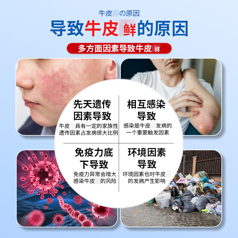 Yaoshen Jingpin 乾癬かゆみ止め軟膏は、頑固な外用皮膚のかゆみ、赤み、中頭皮株を殺菌します。|undefined